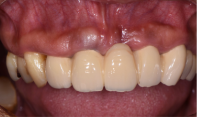 審美インプラントを可能にする歯茎のマネージメント